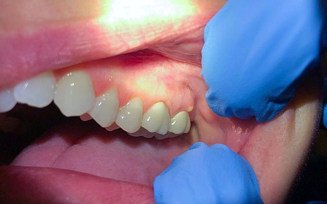 Dental Abscesses Symptoms Causes Treatments Guide