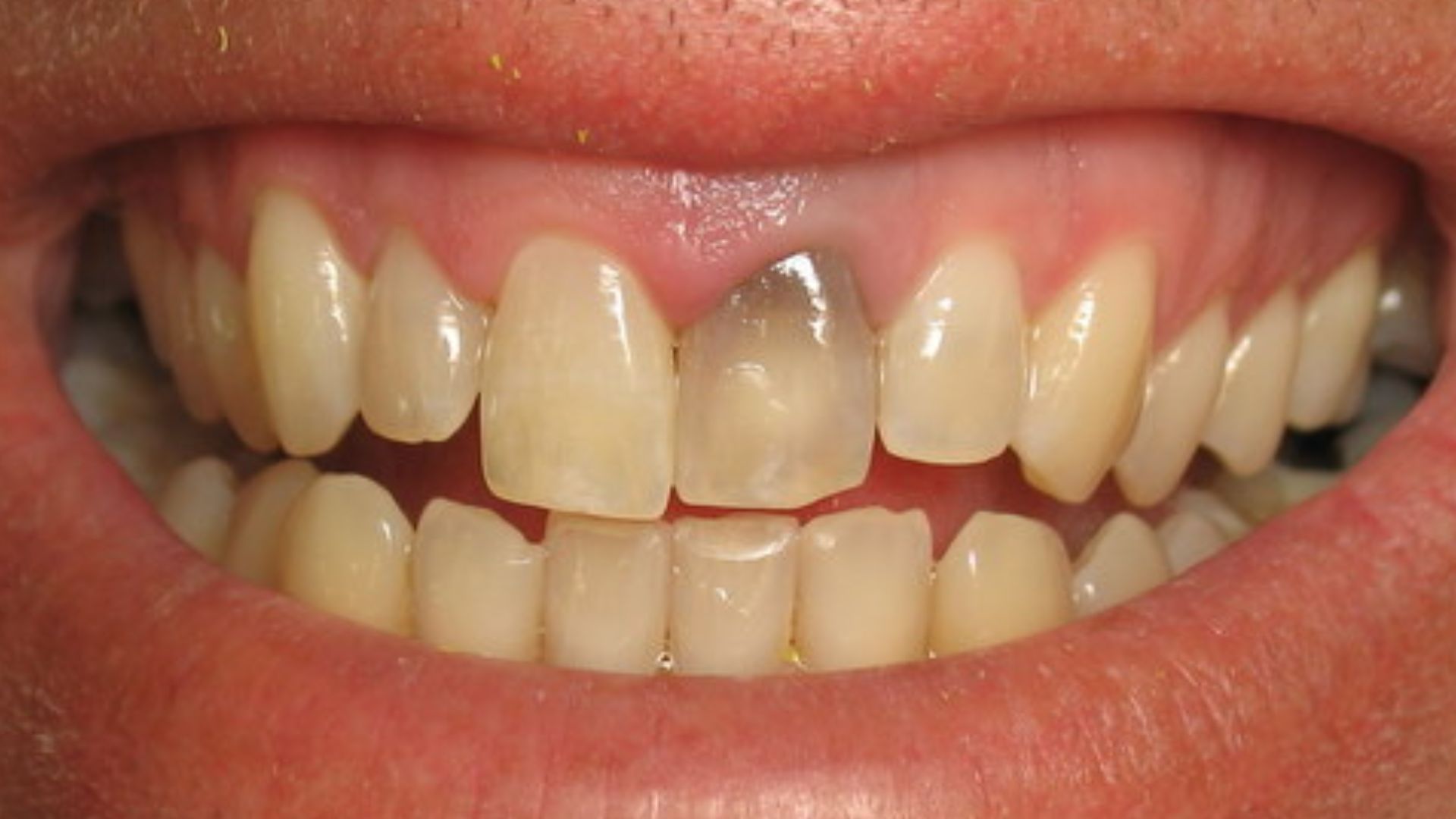 Grey Teeth Causes Treatment Prevention In Bassendean