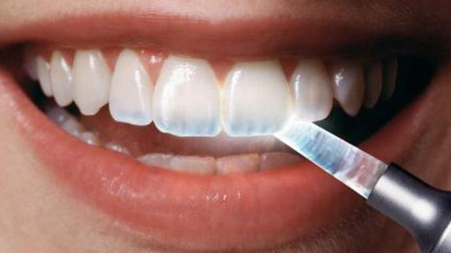 Are Teeth Transparent Enamel Loss Warning Signs Prevent