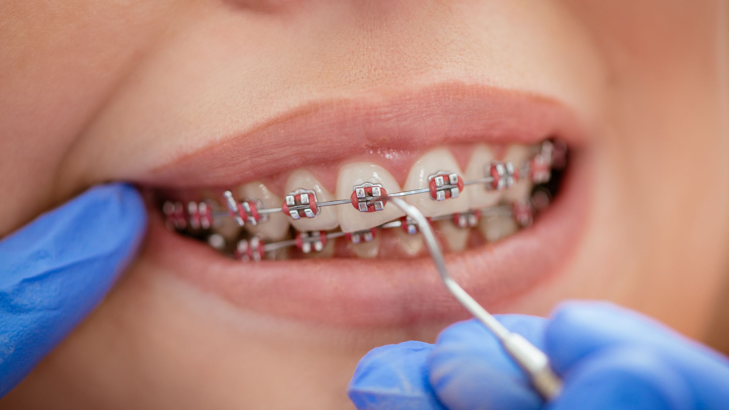 How To Put Wax On Braces How To Handle Common Issues