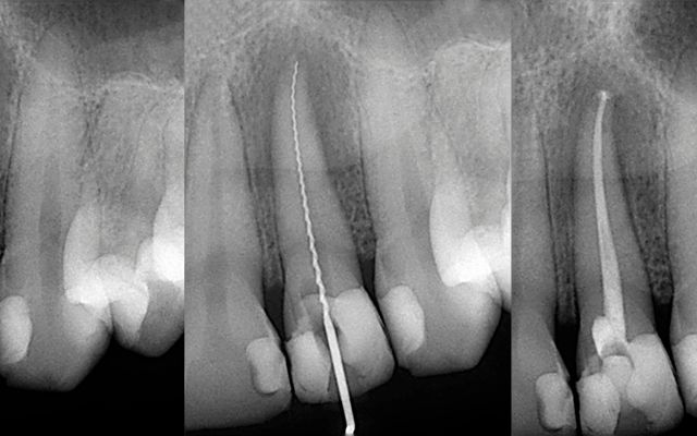 Root Canal Treatment In Bassedean, Perth - Affordable Endodontic