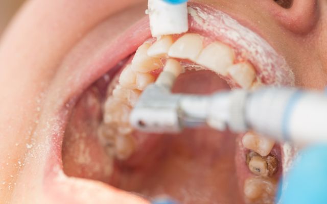 Dental Bonding - Cosmetic Tooth Bonding In Bassendean, Perth