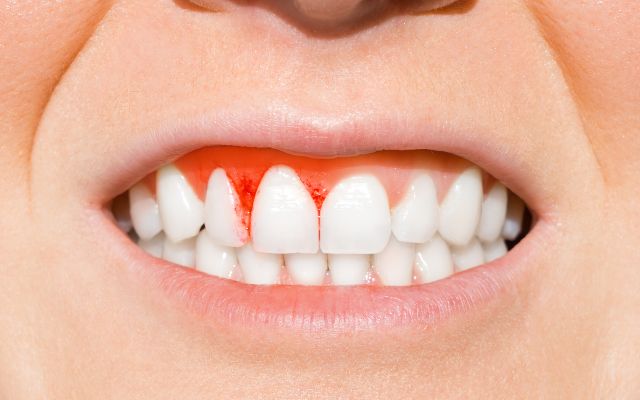 Gingivitis: Causes, Symptoms & Treatments | Bassendean, Perth