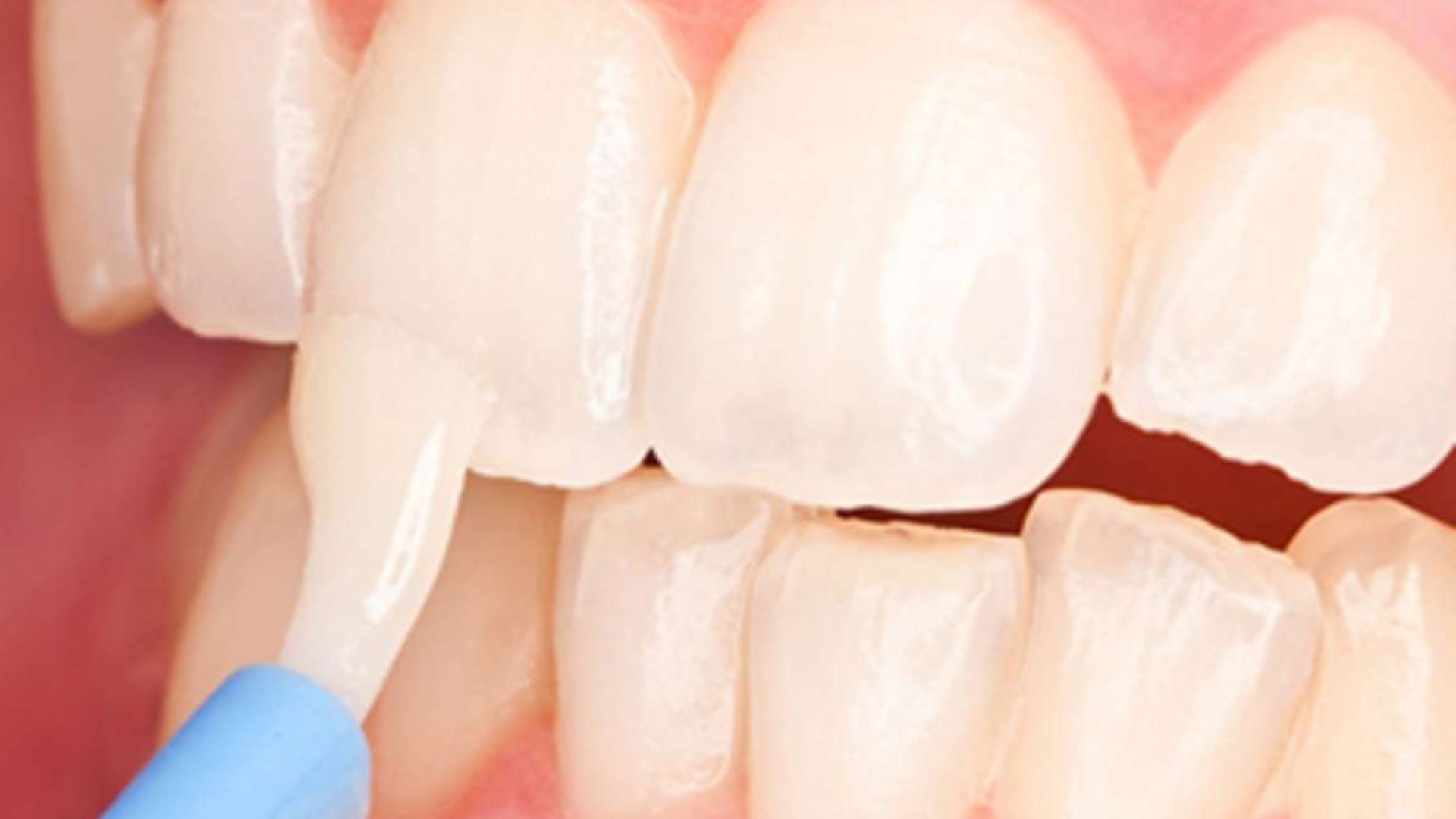 Fluoride Treatment At Spring Orchid Dental, Bassendean