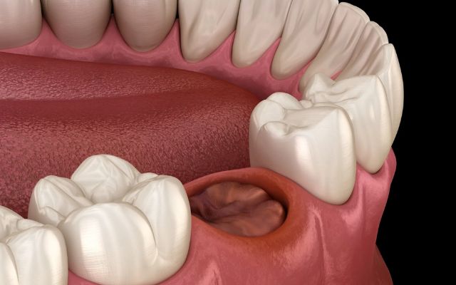 Dry Socket Tooth Causes Symptoms Treatment And Prevention