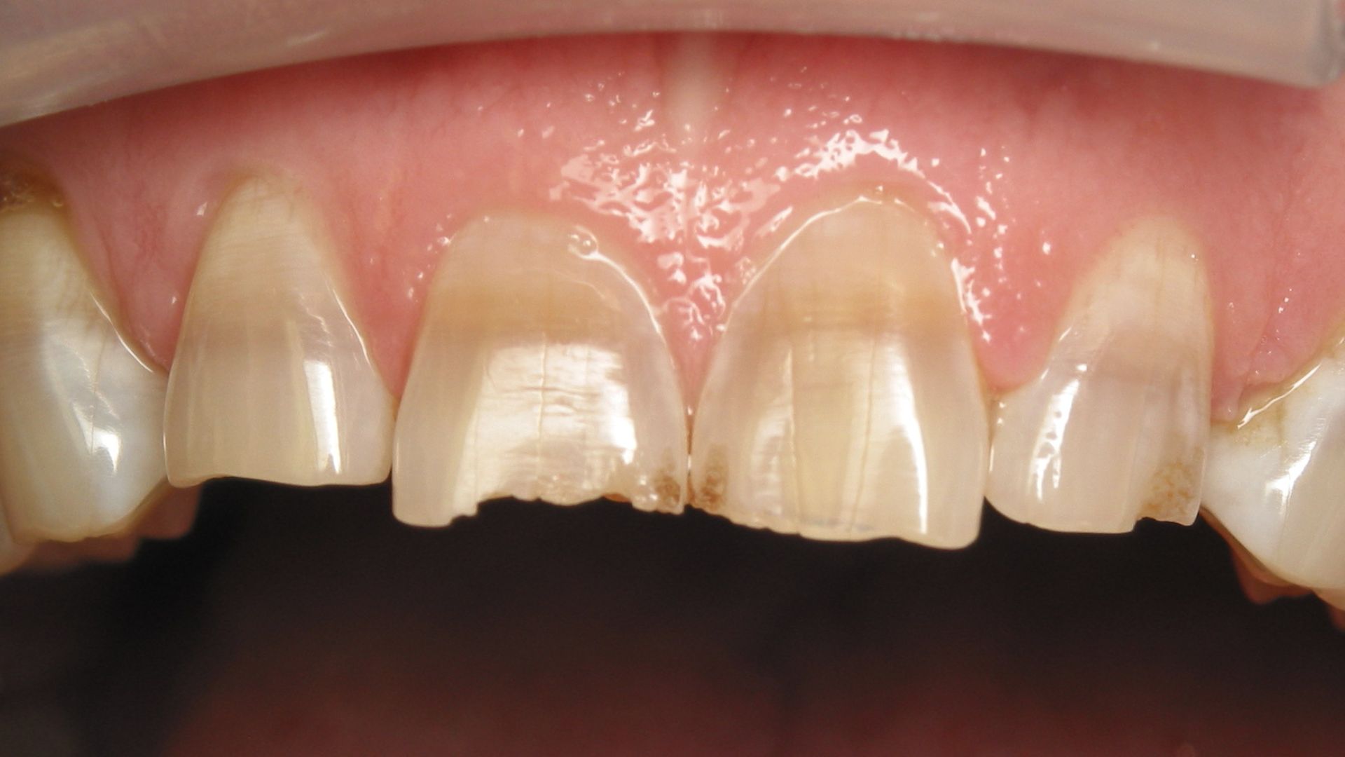 Black Stains On Teeth Causes and Treatment in Bassendean