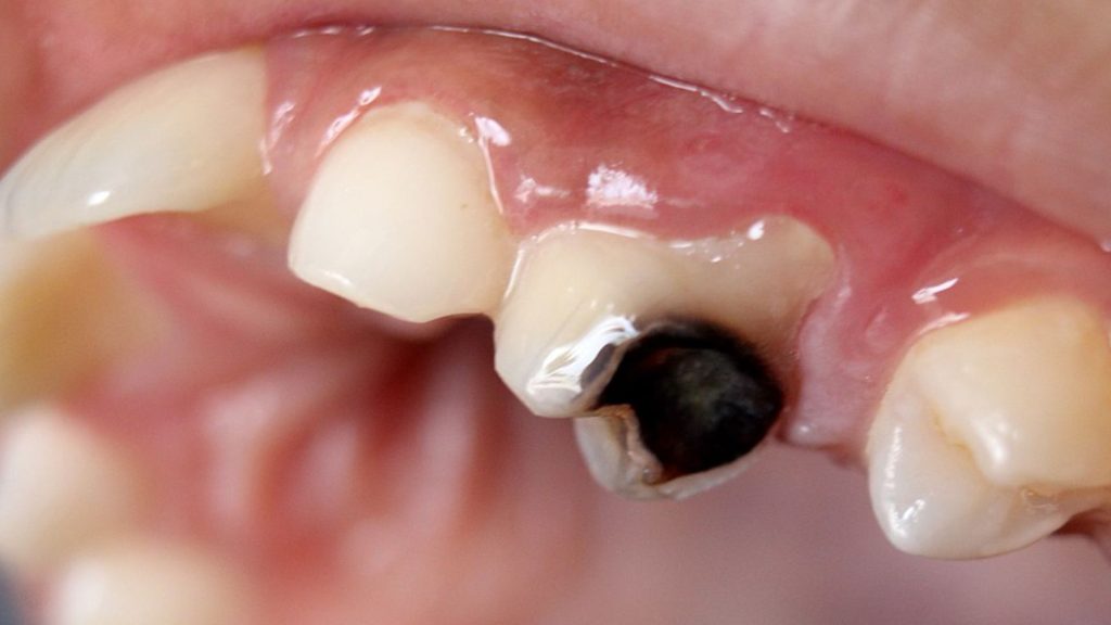 Black Stains On Teeth Causes and Treatment in Bassendean