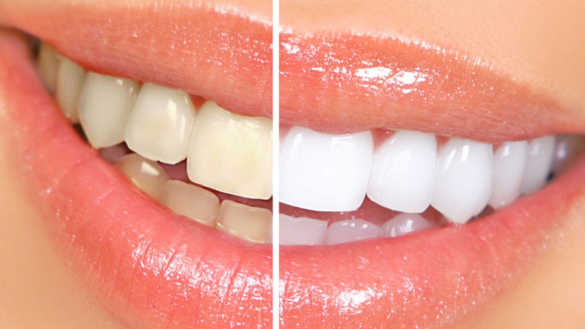 Grey Teeth Causes, Treatment & Prevention in Bassendean