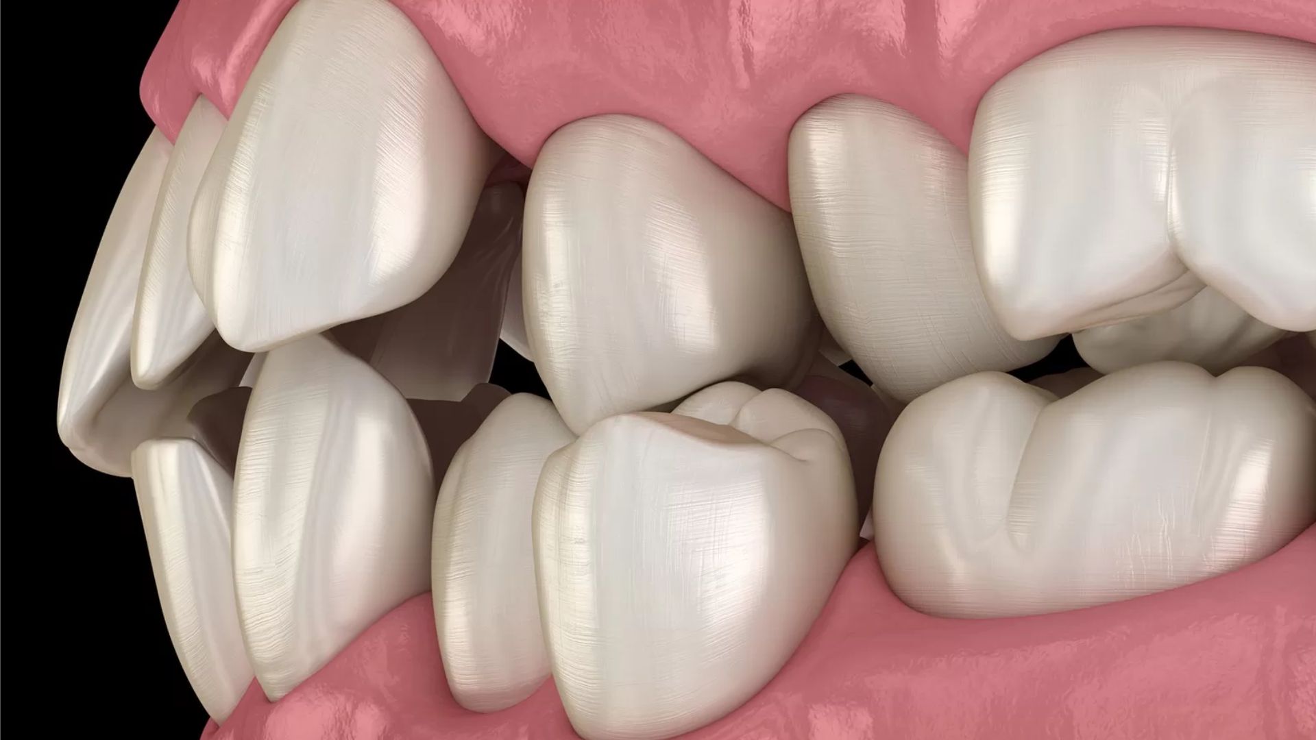 Protruding Teeth Causes & Advice Treatment In Bassendean