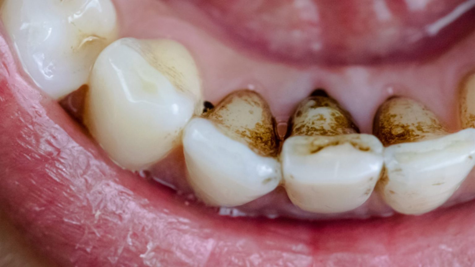 Black Stains On Teeth: Causes and Treatment in Bassendean