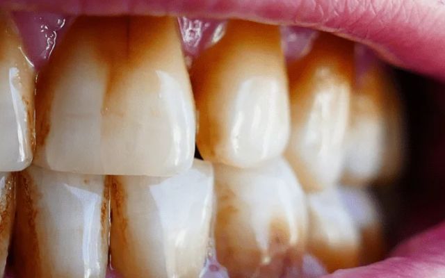 Brown Stains On Teeth: Causes and Treatment in Bassendean