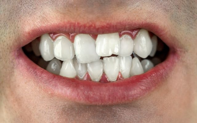 Twisted Teeth: Causes, Symptoms, Treatments & Prevention