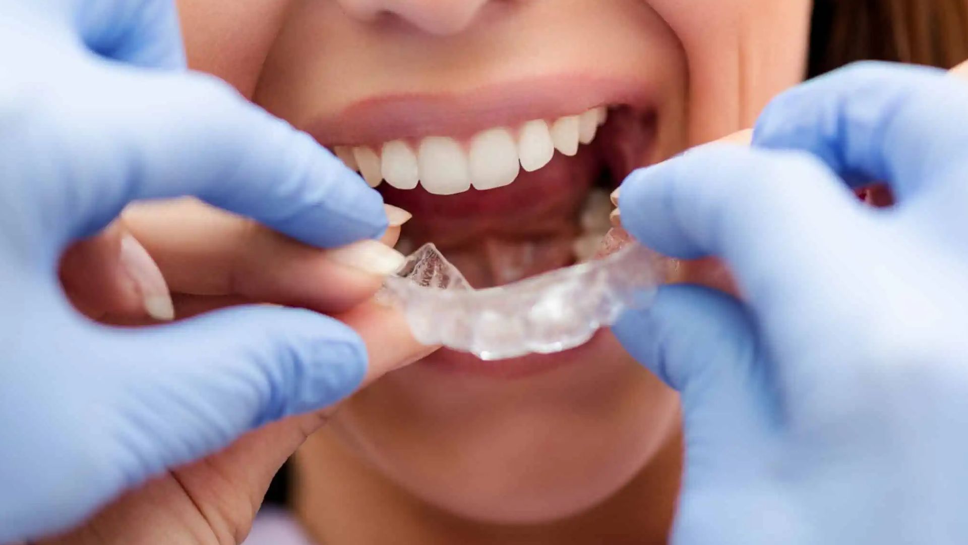 Dental Splint Type, Usage, Preservation & How to Use It