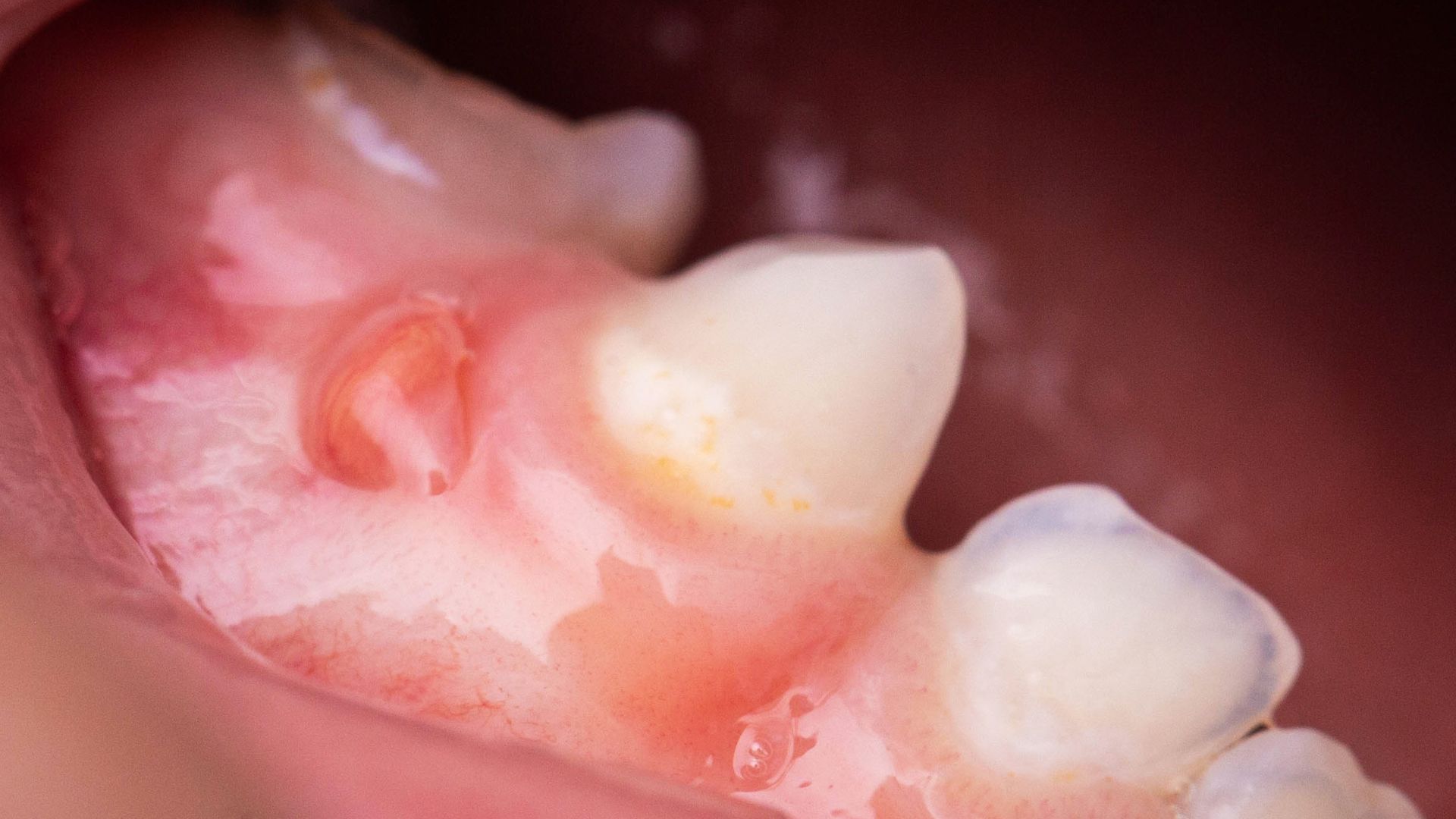Why Is My Gum Purple Around Tooth Swollen Gum Around One Tooth: Symptoms, Causes & Treatment