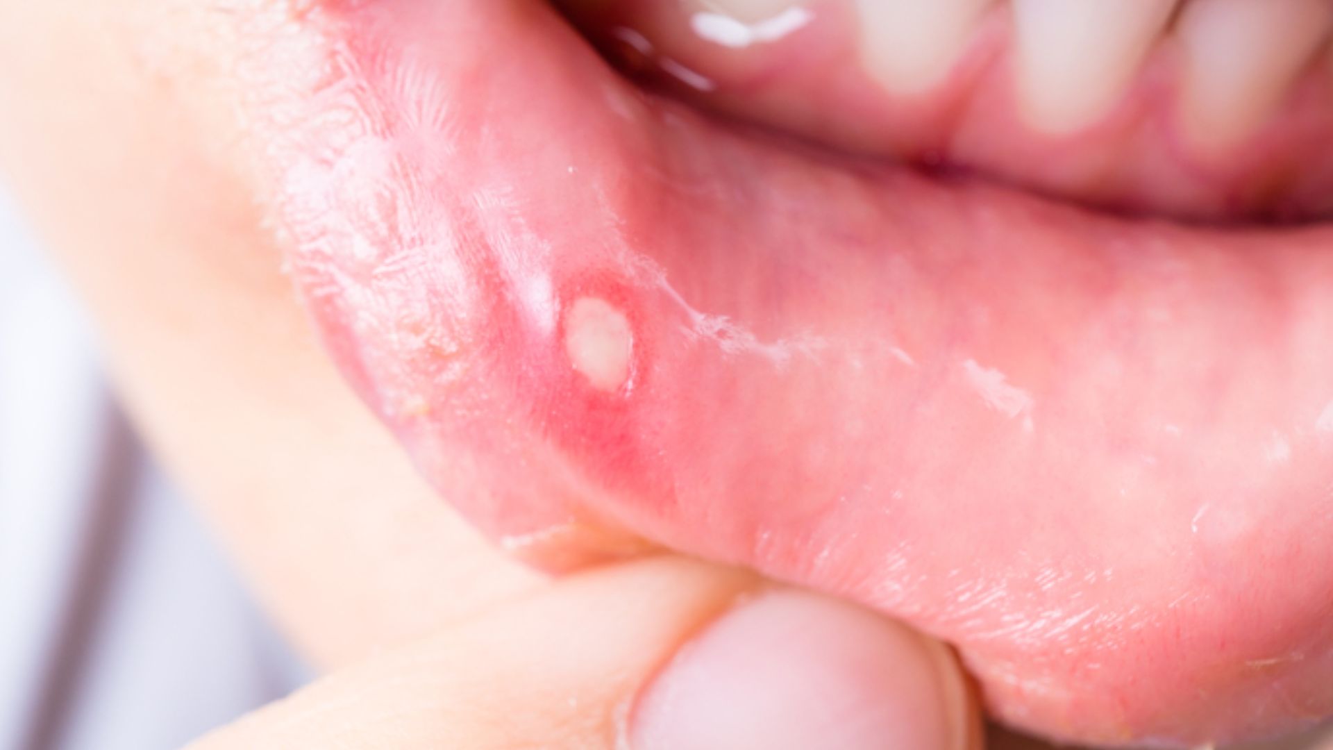 Mouth Ulcers: Types & Treatments At Spring Orchid Dental