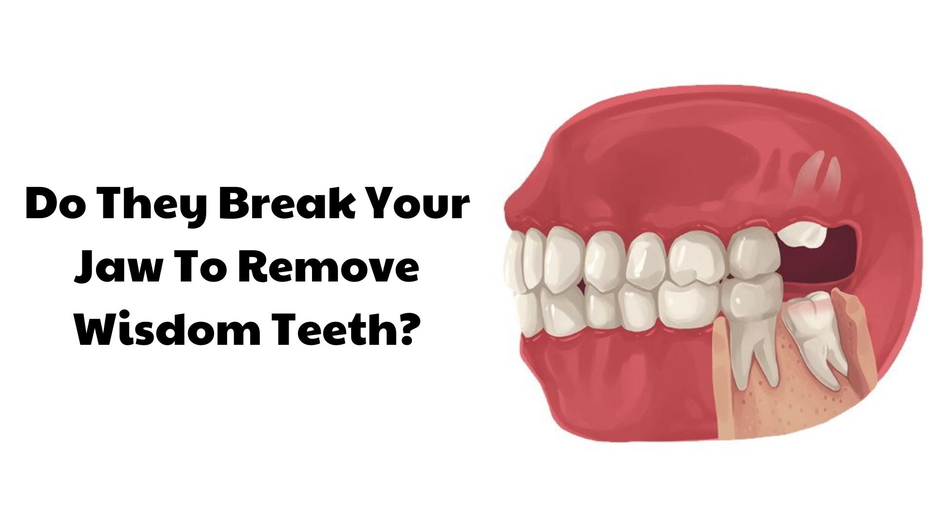 do-they-break-your-jaw-to-remove-wisdom-teeth