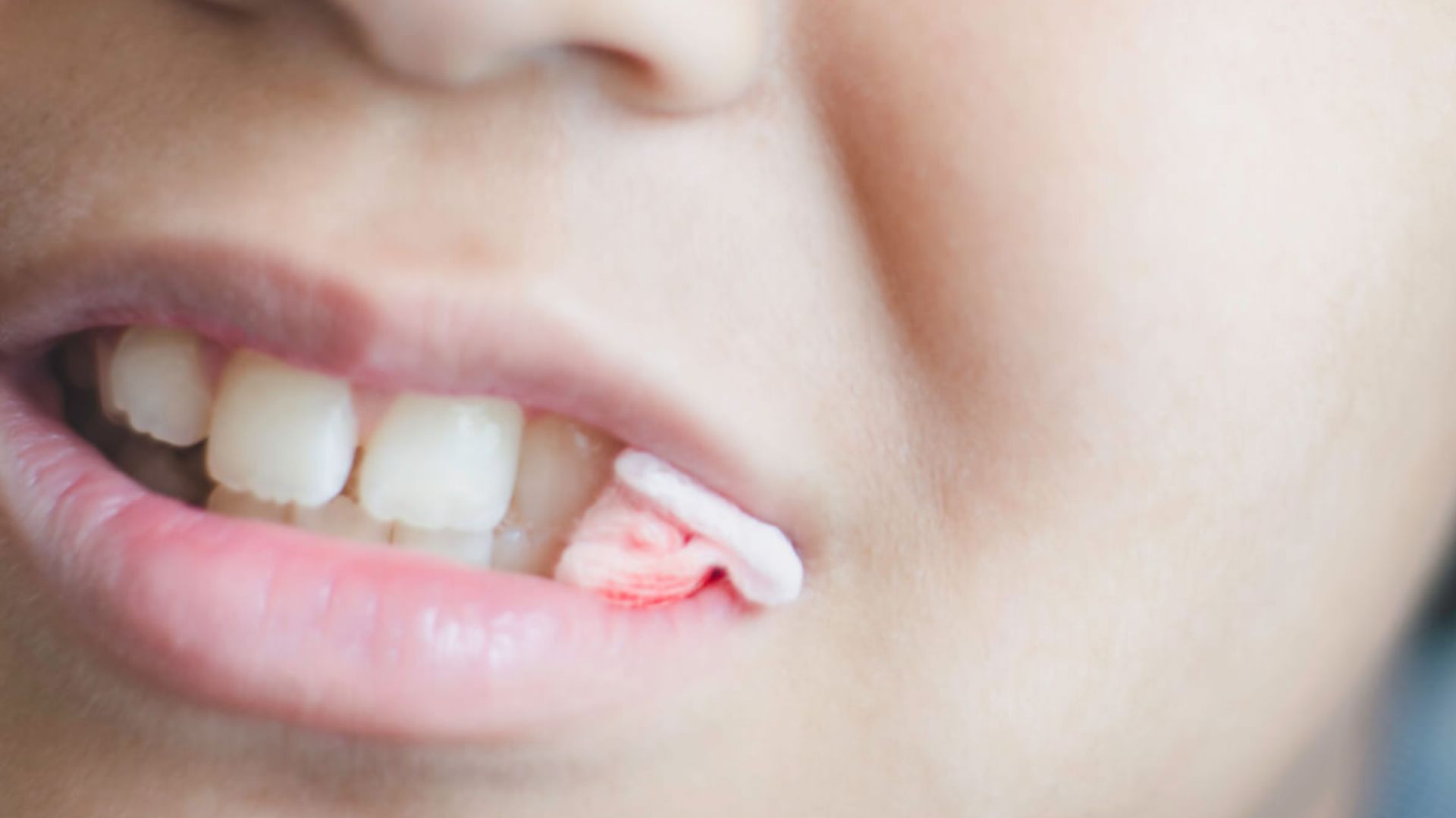 When To Stop Using Gauze After Tooth Extraction? Dentist Answer