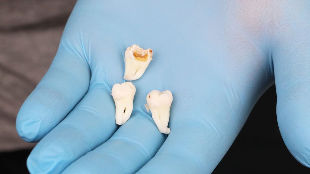 When Can I Brush My Teeth After Wisdom Teeth Removal?
